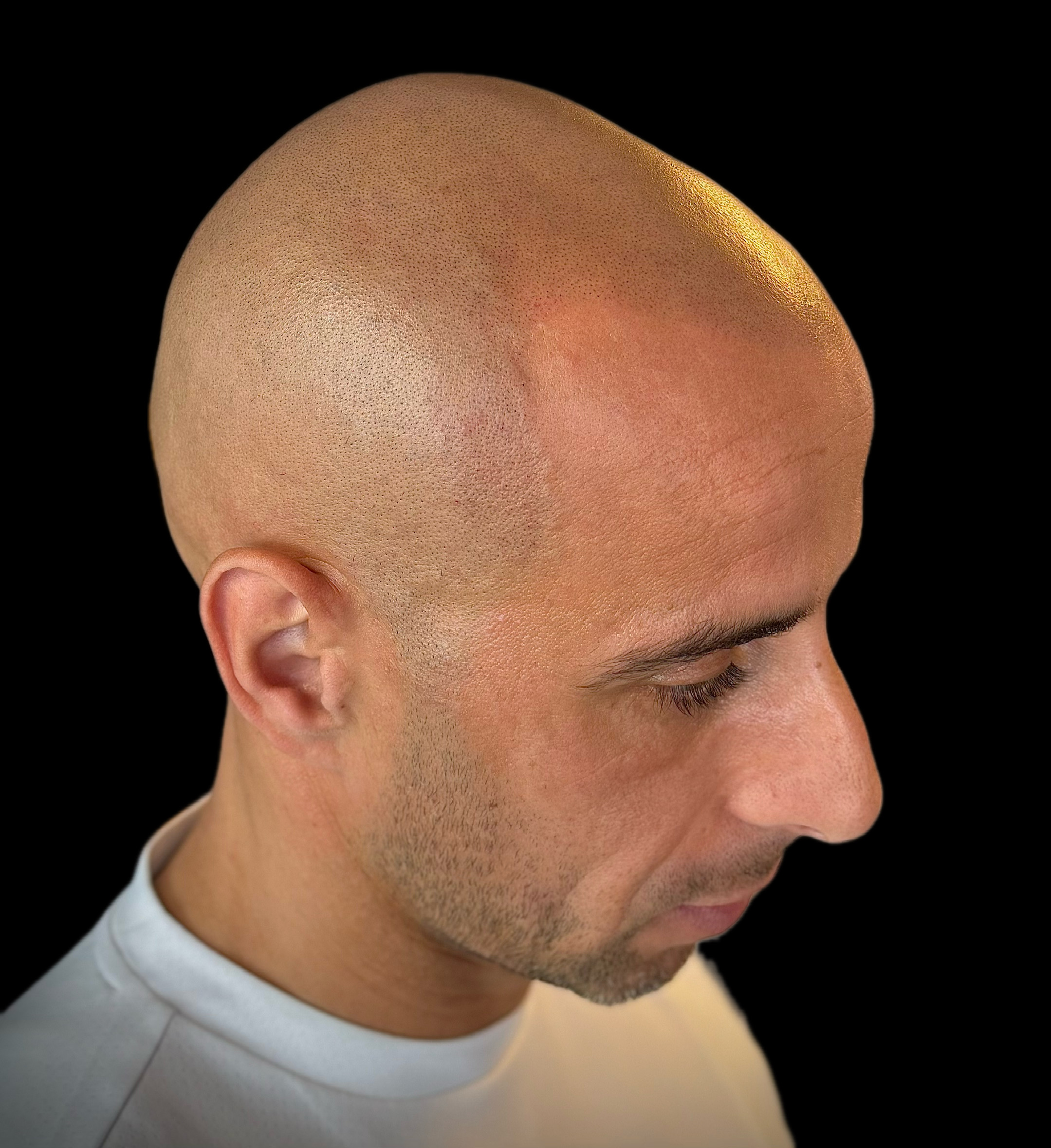 Micro haar pigmentatie in zijaanzicht met een subtiele overgang
